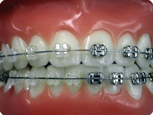 Ceramic Bracket3-3