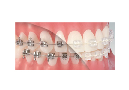 Tooth color coated Archwires